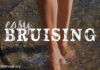 easy bruising