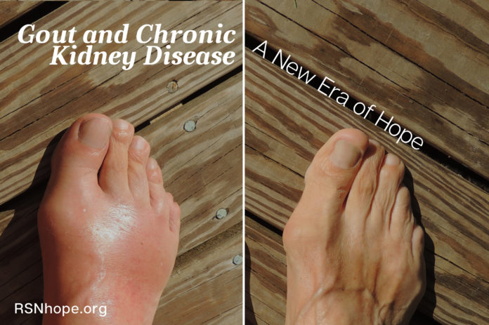 Gout and CKD Patients - Gout and Chronic Kidney Disease