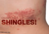 Shingles