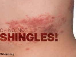 Shingles