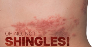 Shingles