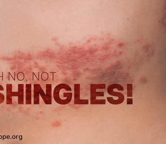 Shingles