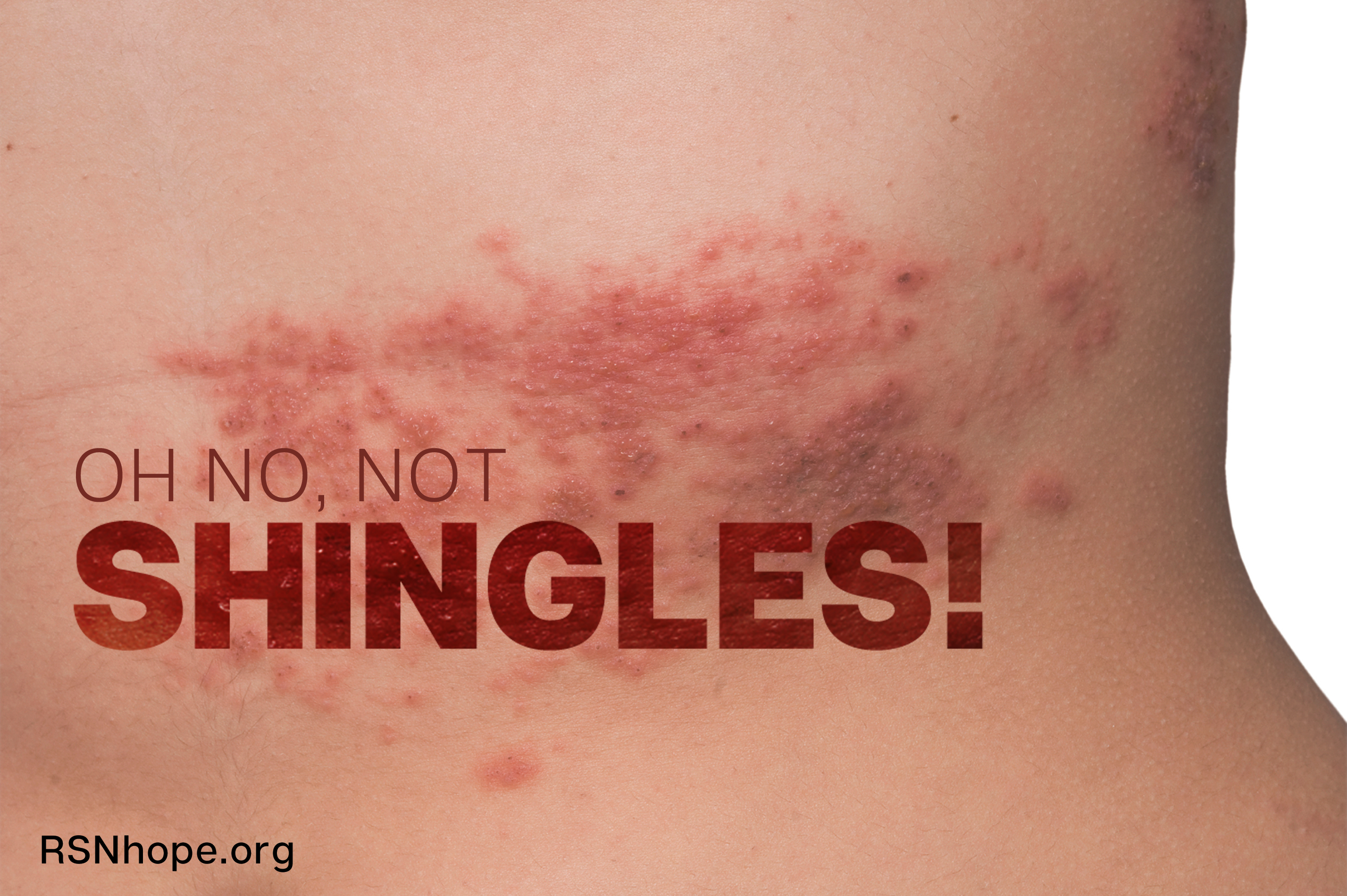 oh no! not shingles! | renal support network