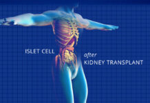 islet cell transplant - kidney talk