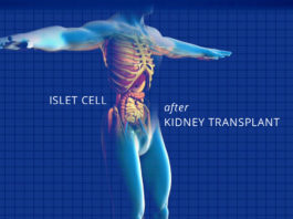 islet cell transplant - kidney talk