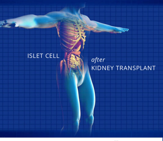 islet cell transplant - kidney talk