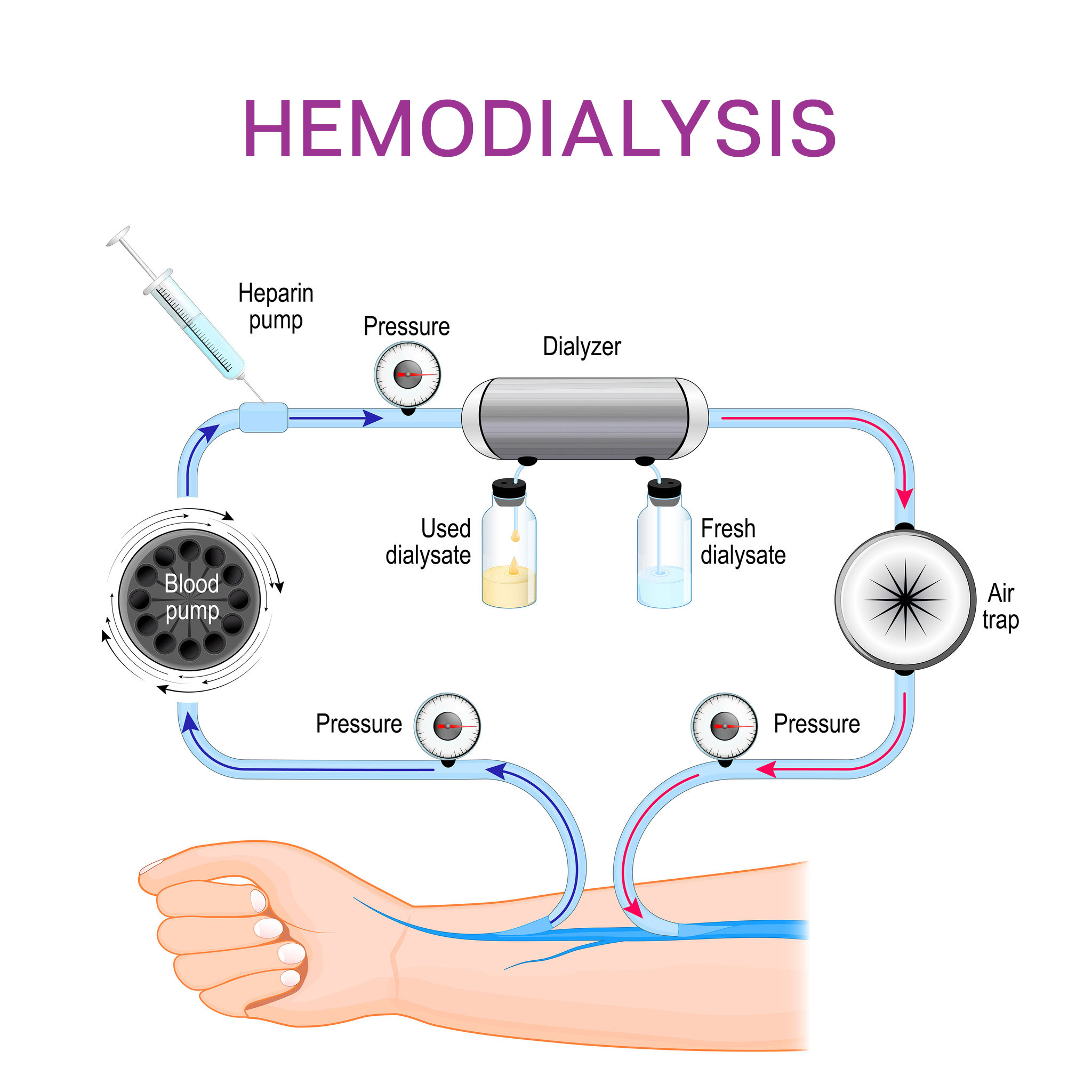 hemodialysis-concept