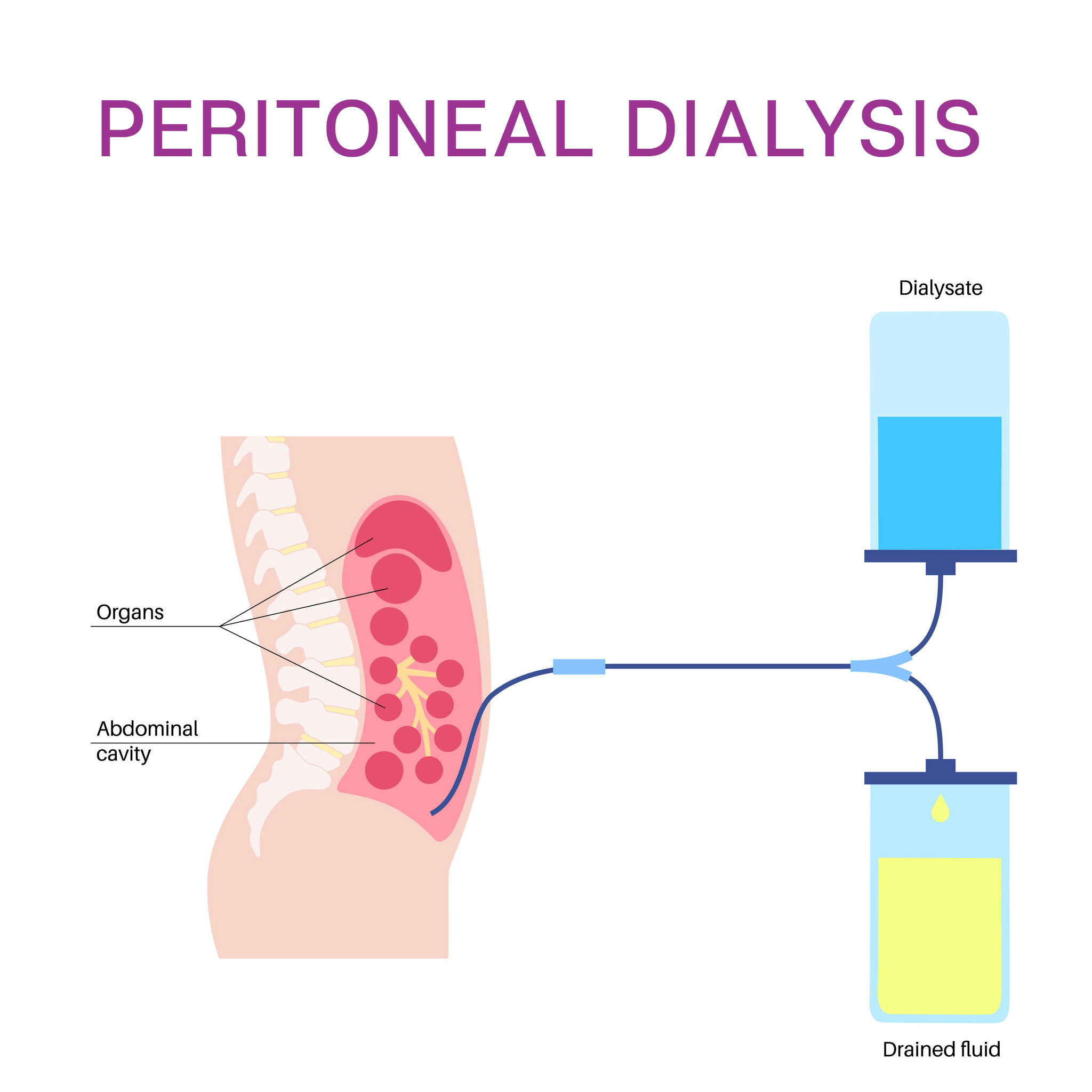 peritoneal-dialysis-concept